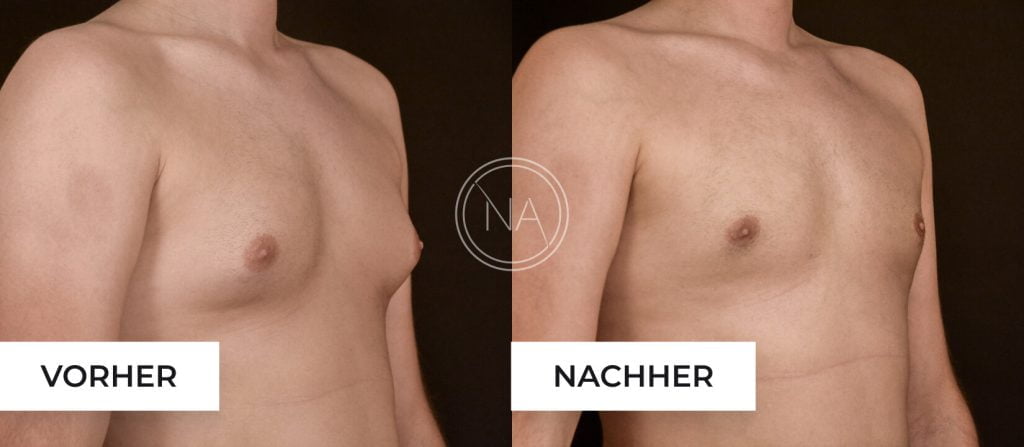 gynäkomastie vorher nachher