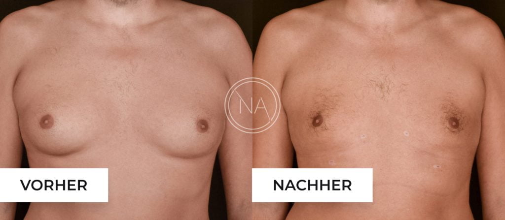 Männerbrust vorher nachher