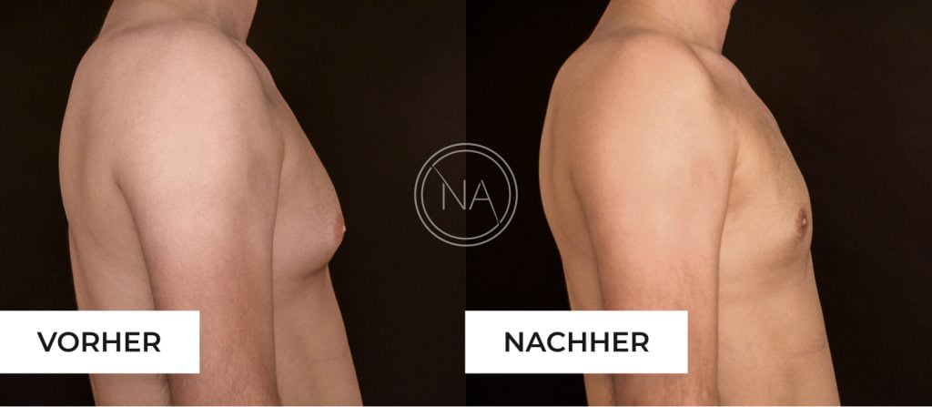 Gynäkomastie Bilder vorher nachher