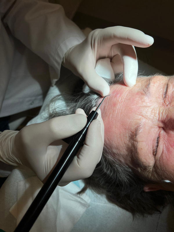 Altersflecken entfernen