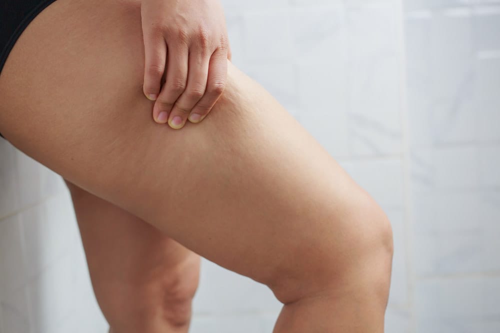Lipödem vs. Adipositas - Unterschiede zweier Krankheitsbilder